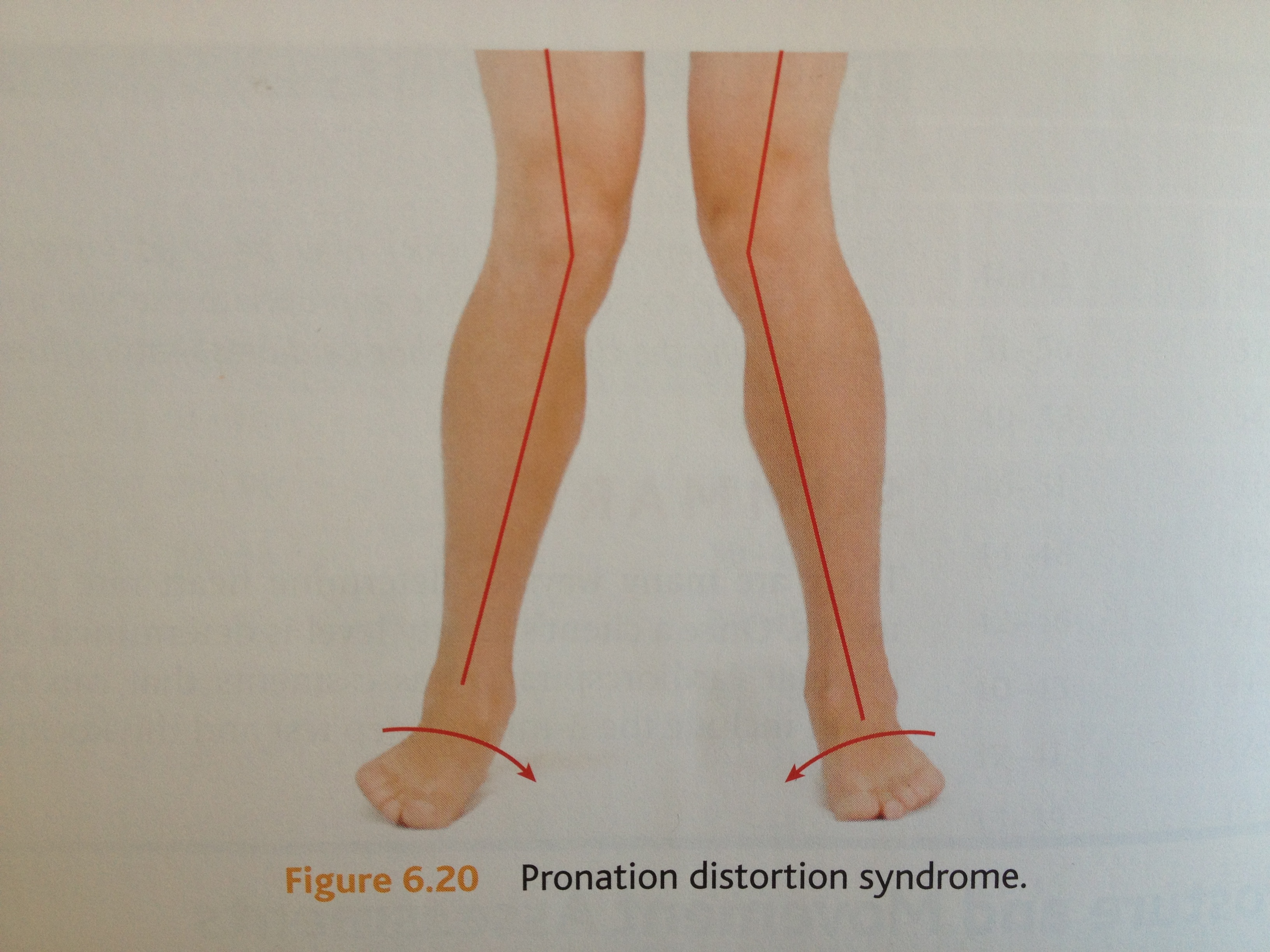 Foot Pronation