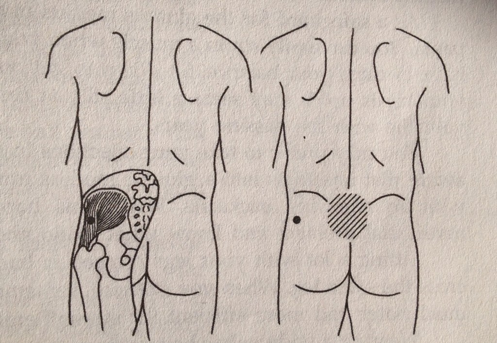 how to get rid of lower back pain gluteus medius how to get rid of lower back pain gluteus medius