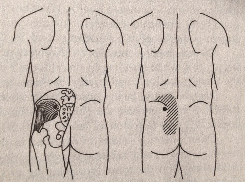 how to get rid of lower back pain gluteus medius quadratus lumborum how to get rid of lower back pain gluteus medius quadratus lumborum