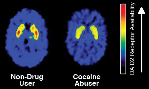 Cocaine Abuse Brain Scan