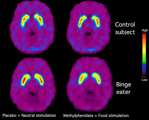 Brain Scan Food Addict